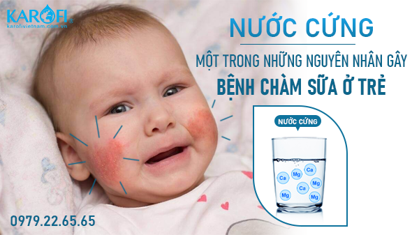 Nước Cứng – Một Trong Những Nguyên Nhân Gây Bệnh Chàm Sữa Ở Trẻ